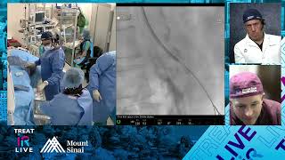 Transradial Stenting of Mesenteric Artery Occlusion for Chronic Mesenteric Ischemia [upl. by Elleinod208]