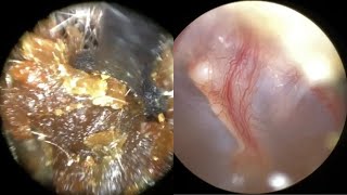 139  Severe Ear Wax Blockage Removed using WAXscope®️amp New Mechanical Instruments [upl. by Rumery554]