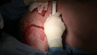 Thigh mass removal with h flank fold flap in a dog [upl. by Gonagle790]