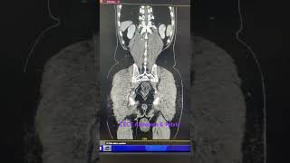 Above CECT findings reveals grade I prostatomegaly with left simple cortical renal cyst as describ [upl. by Weatherley]