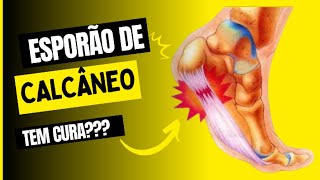 ESPORÃO DE CALCÂNEO  TEM CURA Veja este vídeo [upl. by Atirihs902]