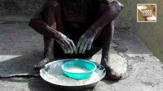 Walhes Untouched Leprosy Patients [upl. by Ahsemot895]