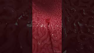 Bleeding gastric ulcer 3d animation anatomy meded [upl. by Alyal21]