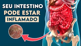 INTESTINO INFLAMADO Sintomas de Doença Inflamatória Intestinal │ Doença de Crohn [upl. by Colpin]