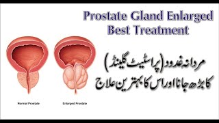 Prostatitis  Prostate Gland Enlargement Best Treatment in Homeopathy by Dr Safdar Iqbal [upl. by Nwadrebma528]