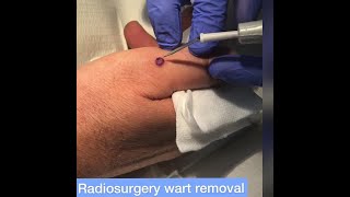 Warts on hand removal by radiosurgery at Cosmedics Skin Clinics London amp Bristol [upl. by Trela]