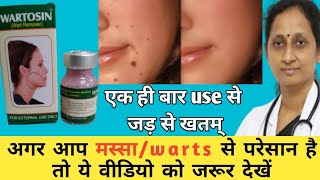 Wartosin Wart Remover  Wartosin kaise use kare  मस्से को जड़ से कैसे हटाये  wartosin Review [upl. by Acenahs]