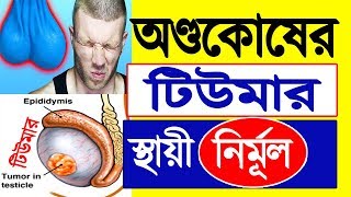 নীরব ঘাতক টেস্টিস বা অন্ডকোষের টিউমার  সুচিকিৎসা হোমিওপ্যাথি [upl. by Ainsley]