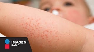 ¿Qué causa la dermatitis atópica  Bien y Saludable [upl. by Eidnam]