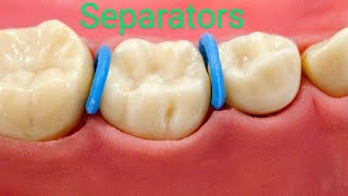 Orthodontic Separators All you need to know [upl. by Cryan]