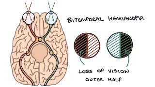 Understanding Bitemporal Hemianopia [upl. by Jeraldine]