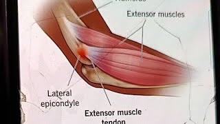 Lateral Epicondylitis Tennis Elbow treatment [upl. by Kylen]