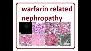 Warfarin Related Nephropathy  2024 [upl. by Odlabu533]