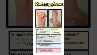 Marfan syndrome shorts marfansyndrome [upl. by Laeahcim]