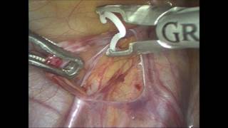 Laparoscopic varicocelectomy using polymer ligating clips [upl. by Yuille]