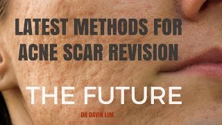 Acne Scar Treatments future looks bright [upl. by Myca]