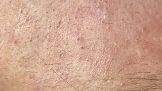 many cheek and forehead blackheads  dermacool 0208 [upl. by Nyrahs58]