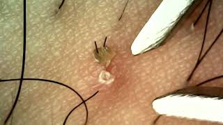 Plucking Hair and Blackheads with Tweezers [upl. by Leibarg903]