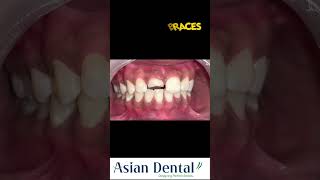 Invisible Braces Treatment in Vijayawada amp Hyderabad  Asian Dental  invisiblebraces happypatient [upl. by Aber]