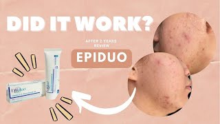 UPDATE AFTER 2 YEARS OF USING EPIDUO Philippines  Andy Buela [upl. by Allecram]