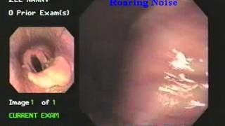 roaring disease laryngeal hemiplegiaby endoscopy [upl. by Wendelina]