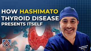 How Hashimato Thyroid disease presents itself [upl. by Nylac682]