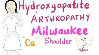 Hydroxyapatite Arthropathy  Milwaukee Soulder [upl. by Cousin334]