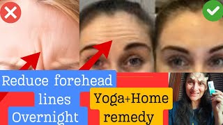 Smooth deep forehead lines over night  Inexpensive Home treatment [upl. by Hiltan923]