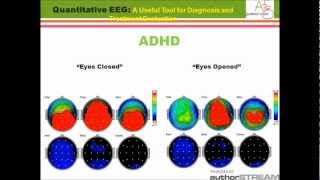 qEEG A Useful Tool for Diagnosis and Treatment Evaluation [upl. by Leora866]