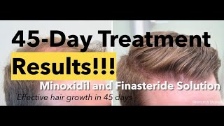 Minoxidil and Finasteride 5 Topical Solution results after 45 days and shedding phase [upl. by Rufe]