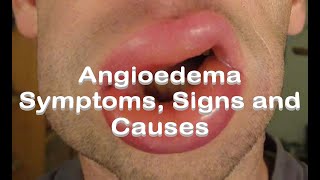 Angioedema  Symptoms Signs and Causes [upl. by Demodena]