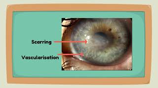 Educational video to support diagnosis of Herpes Simplex Keratitis [upl. by Certie]