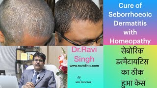 Seborrheic Dermatitis Homoeopathic Cure DrRavi Singh [upl. by Mori]