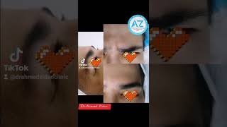 بوتكس تجاعيد اليرجان تجميل Drahmedzidan dermatology botox allergan dysport [upl. by Iarahs]