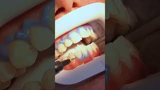 POV whitening my teeth shorts dentist toothwhitening whitenteeth spedup [upl. by Kassaraba]