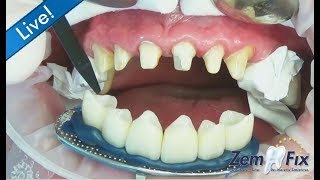 ZemFix®  inserting 6 allceramic zirconia crowns in the upper front [upl. by Neelyaj]