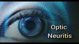 Optic Neuritis Alternative Treatment  Mind Over MS Podcast Episode 18 [upl. by Hamehseer636]