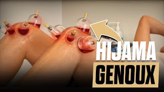 Jai TESTE la HIJAMA sur MES GENOUX arthrose et inflammation genou CUPPING THERAPY remède naturel [upl. by Eneleahs271]