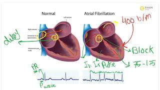 Atrial Fibrillation [upl. by Berlyn]