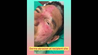 Vitiligo Surgery  Melanocyte Transplantation NCESdrlamoriaskincare [upl. by Wilburn]