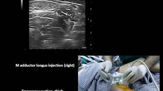 Ultrasound guided lower limb botulinum toxin injections in cerebral palsy Murat Karkucak MD [upl. by Nonrev745]