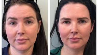 Botox Before and After [upl. by Caresse]