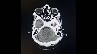 Aqueduct stenosispartial agenesis of corpus callosum residual effects of previous ischemia and HC [upl. by Alrats]