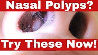 How to Remove Nasal Polyps Yourself  No Surgery Needed [upl. by Samella68]