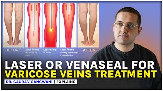 VARICOSE VEINS TREATMENT  LASER ABLATION amp VENASEAL  Dr Gaurav Gangwani [upl. by Nnasus872]