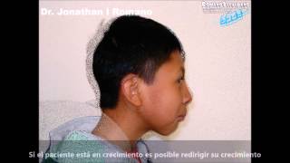 Tratamiento completo de Ortopedia y Ortodoncia con cambio de perfil Dr jonathan l Romano [upl. by Studner450]