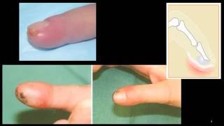 Felon  finger pulp infection [upl. by Alrak]