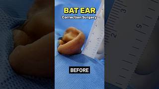 Bat Ear Correction Surgery Cost  Otoplasty Surgery Cost in India [upl. by Mendy]