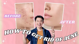 Clear Skin Secrets How to Get Rid of Acne🎀  2024  skincare acne problems skin beauty skincare [upl. by Eliseo354]