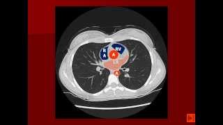 Normal Chest CT with labels [upl. by Stegman]